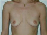breast augmentation